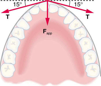 Braces produce a net force on a protruding tooth.
